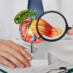 pancreatitis-aguda-de-origen-biliar